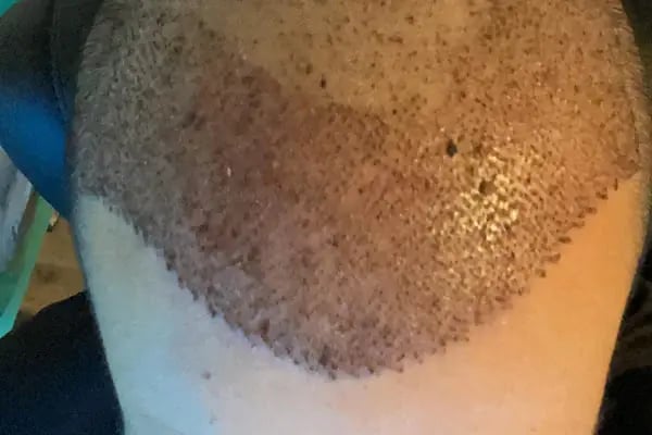 Emphair Hair Transplantation Premium Istanbul Clinic - Saç Ekimi - EMPCLINICS - Resim 10