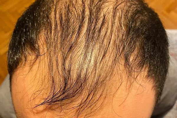 Emphair Hair Transplantation Premium Istanbul Clinic - Saç Ekimi - EMPCLINICS - Resim 20