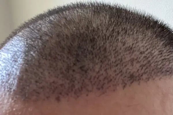 Emphair Hair Transplantation Premium Istanbul Clinic - Saç Ekimi - EMPCLINICS - Resim 11