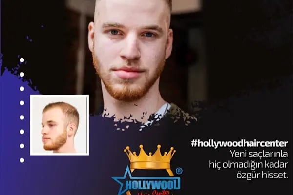 Alanya hairtransplant and prosthetic hair Center ( Alanya saç ekimi ve protez saç merkezi ) - Resim 5