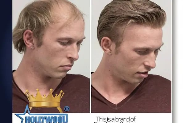 Alanya hairtransplant and prosthetic hair Center ( Alanya saç ekimi ve protez saç merkezi ) - Resim 7