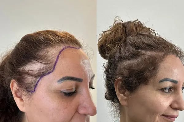 Likya Saç Ekim &amp; Estetik | Alsancak - Resim 4