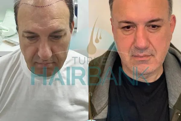 Turkey Hair Bank - Resim 4