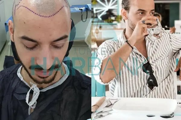 Turkey Hair Bank - Resim 3