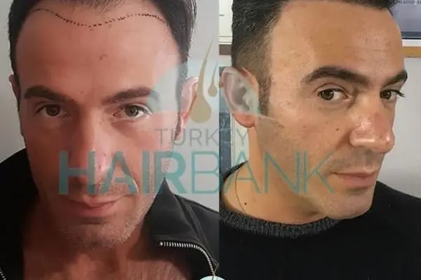 Turkey Hair Bank - Resim 12