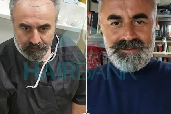 Turkey Hair Bank - Resim 7