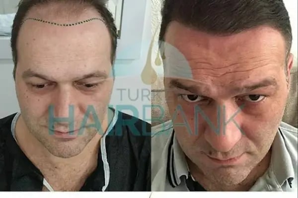Turkey Hair Bank - Resim 6