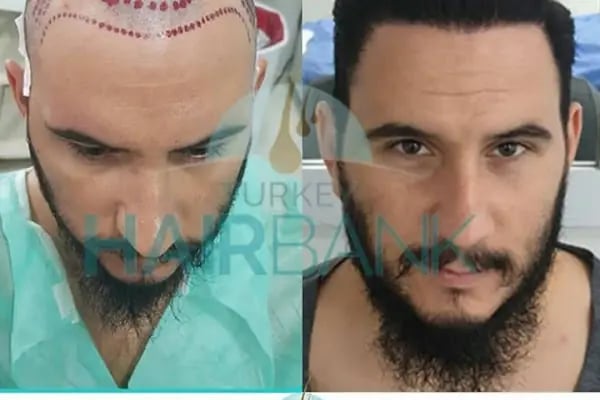 Turkey Hair Bank - Resim 8