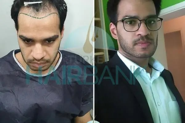 Turkey Hair Bank - Resim 11