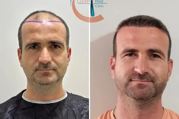 Clean Saç Ekim Merkezi - Resim 8
