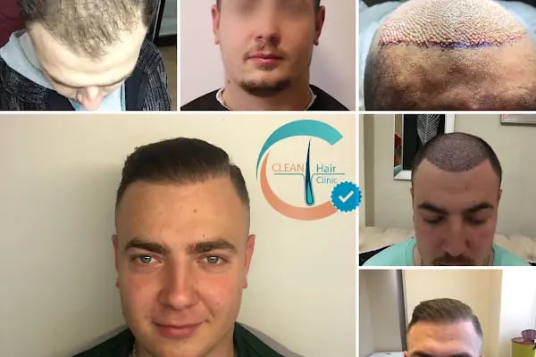 Clean Saç Ekim Merkezi - Resim 13