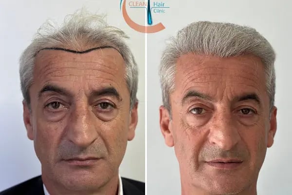 Clean Saç Ekim Merkezi - Resim 9
