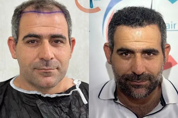 Clean Saç Ekim Merkezi - Resim 7