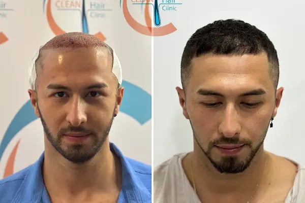 Clean Saç Ekim Merkezi - Resim 11