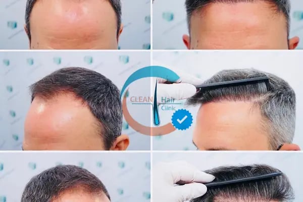 Clean Saç Ekim Merkezi - Resim 19