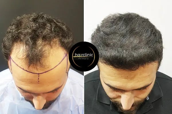Egemen Güdül Hair Clinic Ankara Saç Ekim Merkezi Ankara - Resim 20