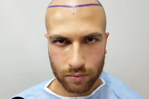 Egemen Güdül Hair Clinic Ankara Saç Ekim Merkezi Ankara - Resim 16