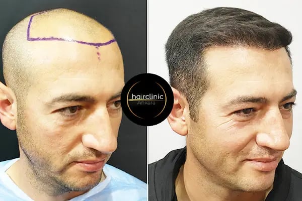Egemen Güdül Hair Clinic Ankara Saç Ekim Merkezi Ankara - Resim 5