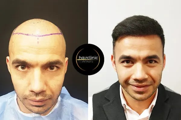 Egemen Güdül Hair Clinic Ankara Saç Ekim Merkezi Ankara - Resim 7