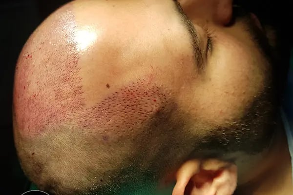 Egemen Güdül Hair Clinic Ankara Saç Ekim Merkezi Ankara - Resim 13