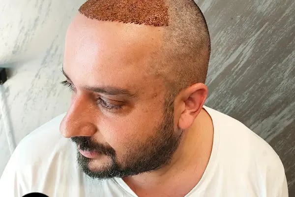 Egemen Güdül Hair Clinic Ankara Saç Ekim Merkezi Ankara - Resim 15