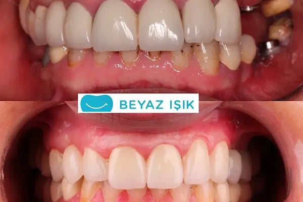 Beyaz Işık Ağız ve Diş Sağlığı Merkezi - Resim 20