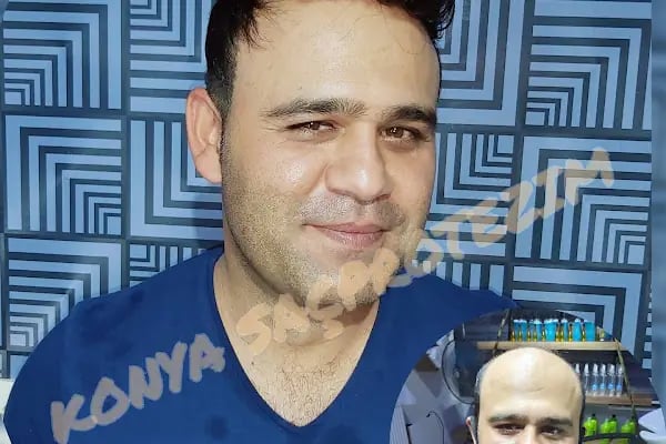 Nafiz Keskin Protez Saç Kliniği - Resim 4