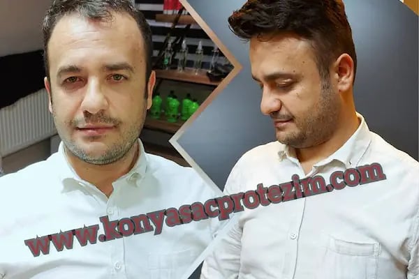 Nafiz Keskin Protez Saç Kliniği - Resim 14