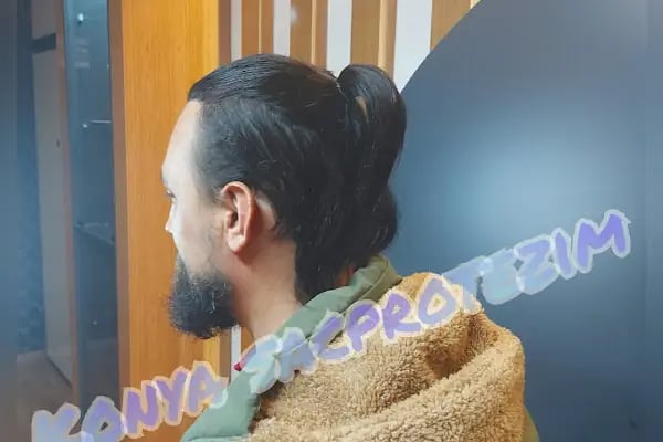 Nafiz Keskin Protez Saç Kliniği - Resim 8
