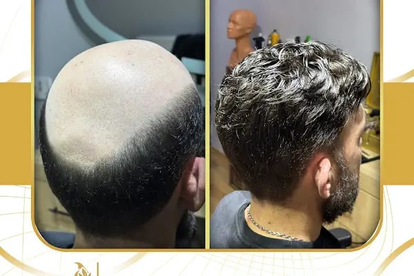 Nafiz Keskin Protez Saç Kliniği - Resim 2