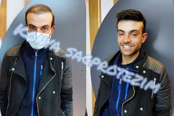 Nafiz Keskin Protez Saç Kliniği - Resim 16