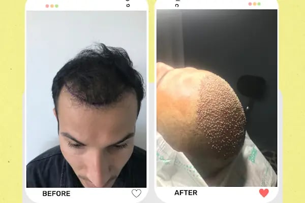 Estetik &amp; güzellik Şanliurfa Saç Ekim Merkezi /زراعة الشعر في أورفا - Resim 11