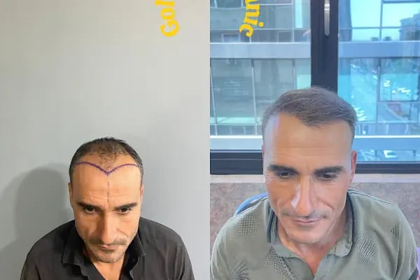 Estetik &amp; güzellik Şanliurfa Saç Ekim Merkezi /زراعة الشعر في أورفا - Resim 8