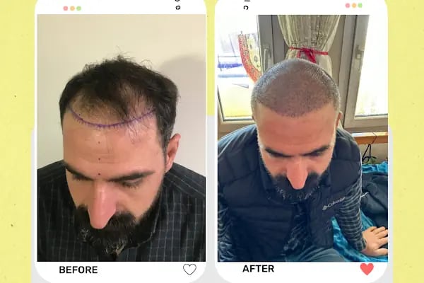 Estetik &amp; güzellik Şanliurfa Saç Ekim Merkezi /زراعة الشعر في أورفا - Resim 16