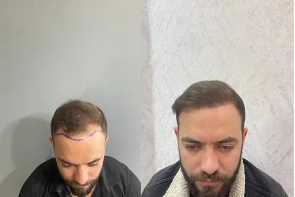 Estetik &amp; güzellik Şanliurfa Saç Ekim Merkezi /زراعة الشعر في أورفا - Resim 17