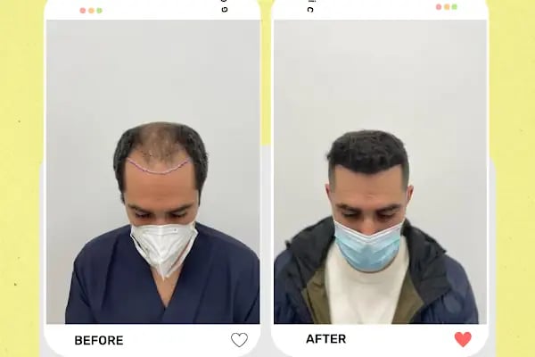 Estetik &amp; güzellik Şanliurfa Saç Ekim Merkezi /زراعة الشعر في أورفا - Resim 13