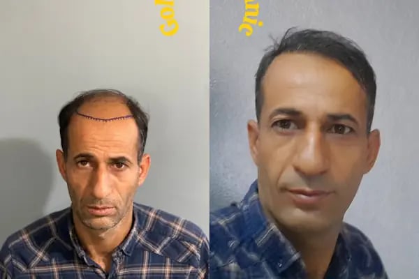 Estetik &amp; güzellik Şanliurfa Saç Ekim Merkezi /زراعة الشعر في أورفا - Resim 6