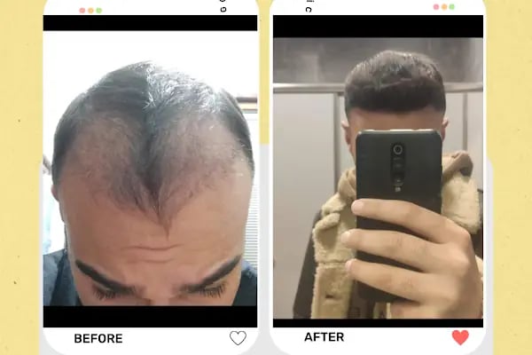 Estetik &amp; güzellik Şanliurfa Saç Ekim Merkezi /زراعة الشعر في أورفا - Resim 10