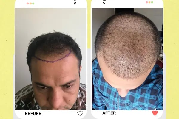 Estetik &amp; güzellik Şanliurfa Saç Ekim Merkezi /زراعة الشعر في أورفا - Resim 14