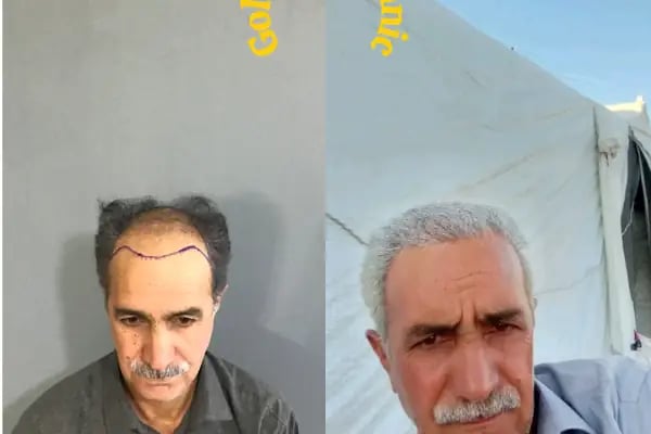Estetik &amp; güzellik Şanliurfa Saç Ekim Merkezi /زراعة الشعر في أورفا - Resim 7