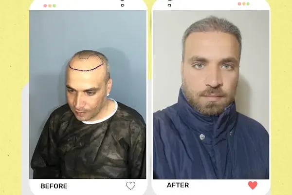 Estetik &amp; güzellik Şanliurfa Saç Ekim Merkezi /زراعة الشعر في أورفا - Resim 12