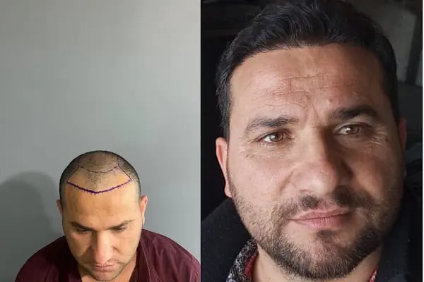 Estetik &amp; güzellik Şanliurfa Saç Ekim Merkezi /زراعة الشعر في أورفا - Resim 9