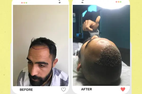 Estetik &amp; güzellik Şanliurfa Saç Ekim Merkezi /زراعة الشعر في أورفا - Resim 15