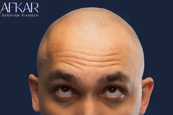 Turkish Hair Transplants - AFKAR - Hair Transplant Turkey, Istanbul - Resim 16