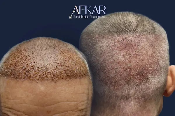 Turkish Hair Transplants - AFKAR - Hair Transplant Turkey, Istanbul - Resim 1