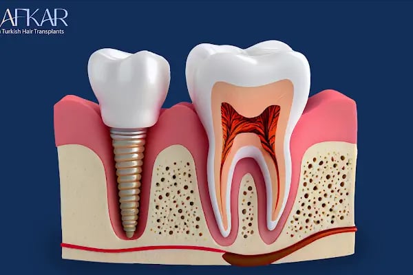 Turkish Hair Transplants - AFKAR - Hair Transplant Turkey, Istanbul - Resim 20