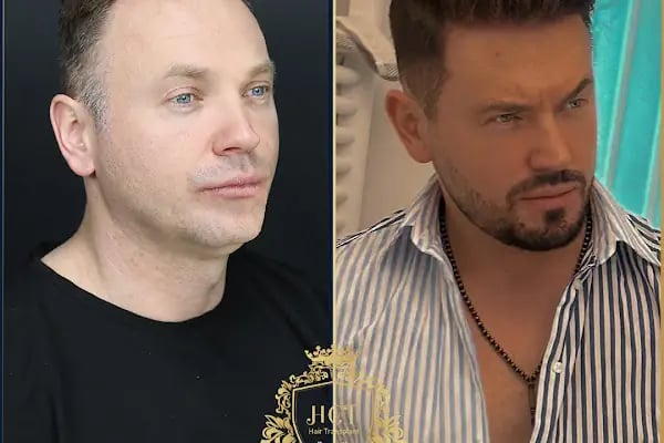 HIV Positive Hair Transplant in Turkey - Resim 10