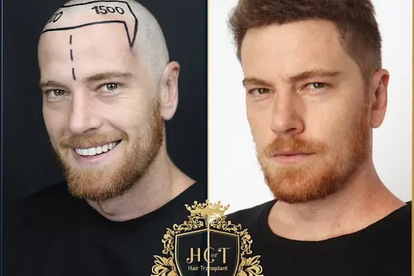 HIV Positive Hair Transplant in Turkey - Resim 15