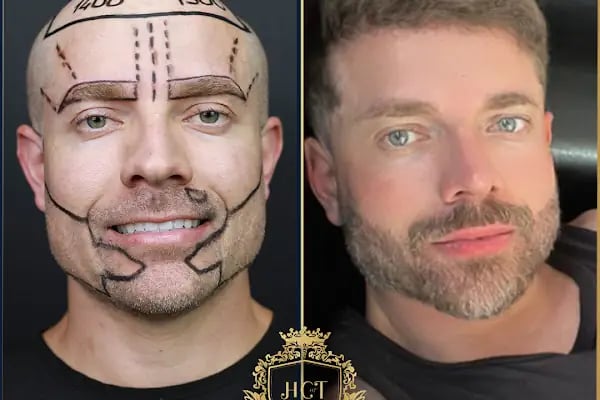 HIV Positive Hair Transplant in Turkey - Resim 11