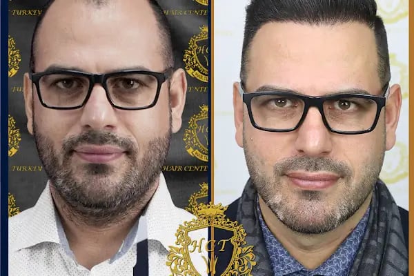 HIV Positive Hair Transplant in Turkey - Resim 12